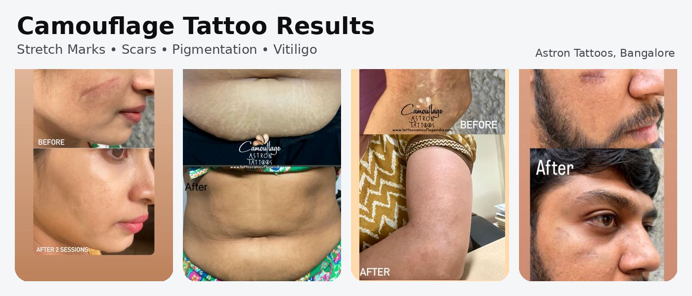 Camouflage Tattoos for Stretch marks and scar removal in India img 2964