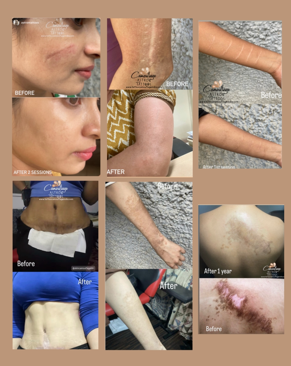 Camouflage Tattoos for Stretch marks and scar removal in India Camouflage tattoo consultation in India