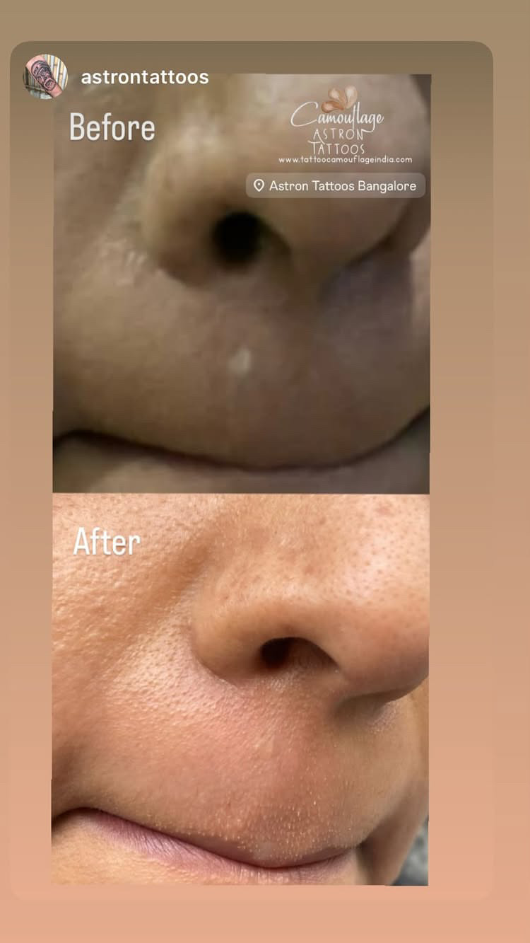Camouflage Tattoos for Stretch marks and scar removal in India Scar camouflage before and after 4