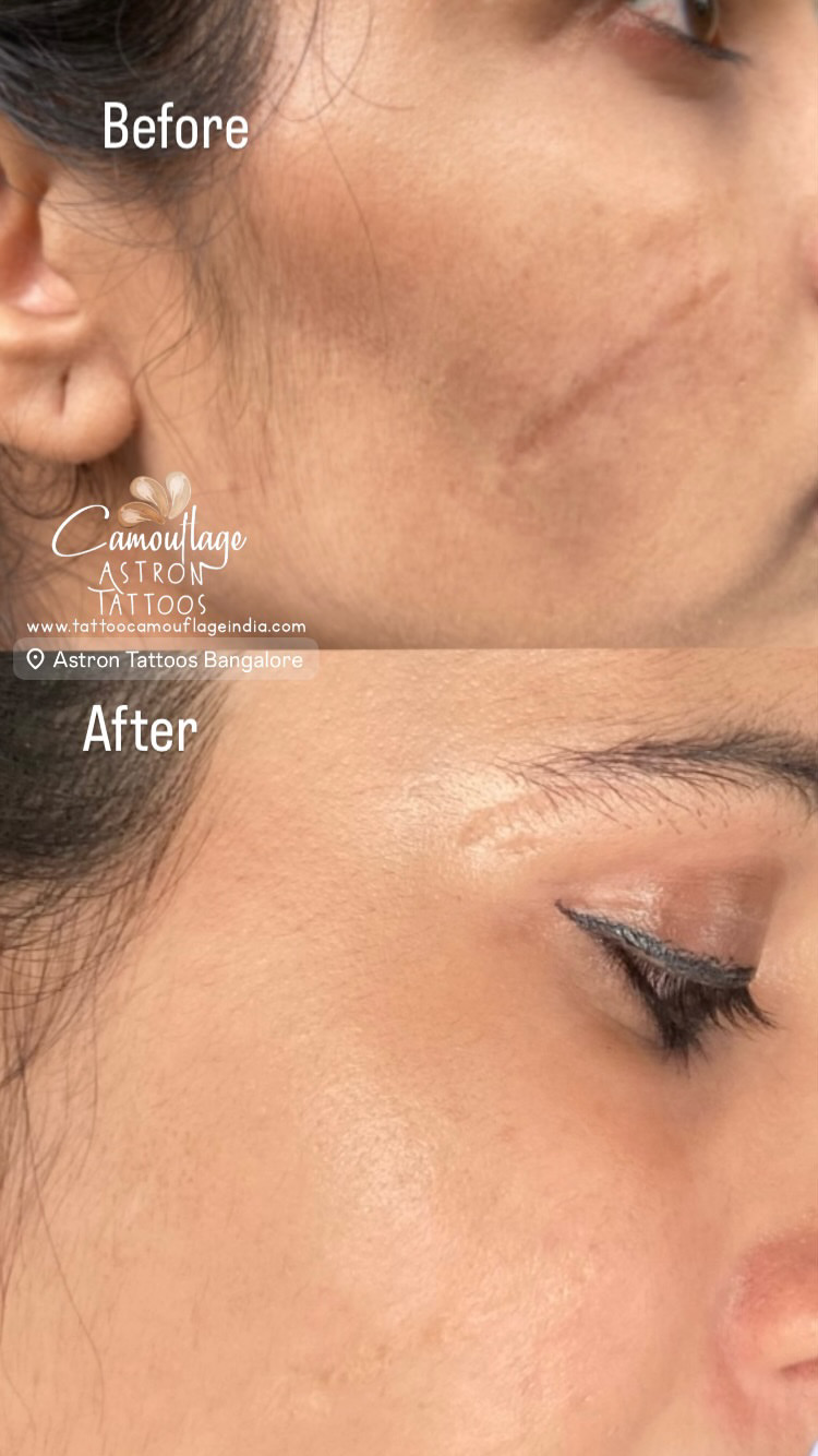 Camouflage Tattoos for Stretch marks and scar removal in India Scar camouflage before and after 2