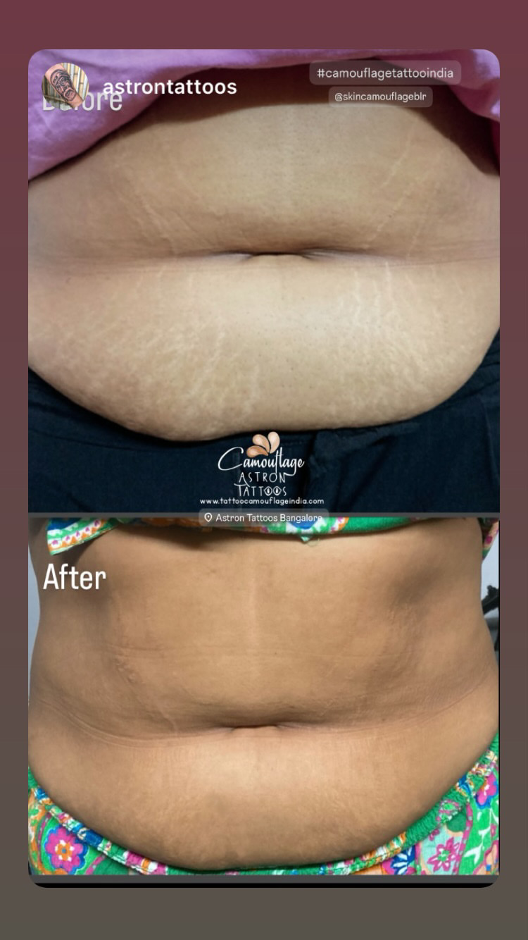 Camouflage Tattoos for Stretch marks and scar removal in India Scar camouflage before and after 1