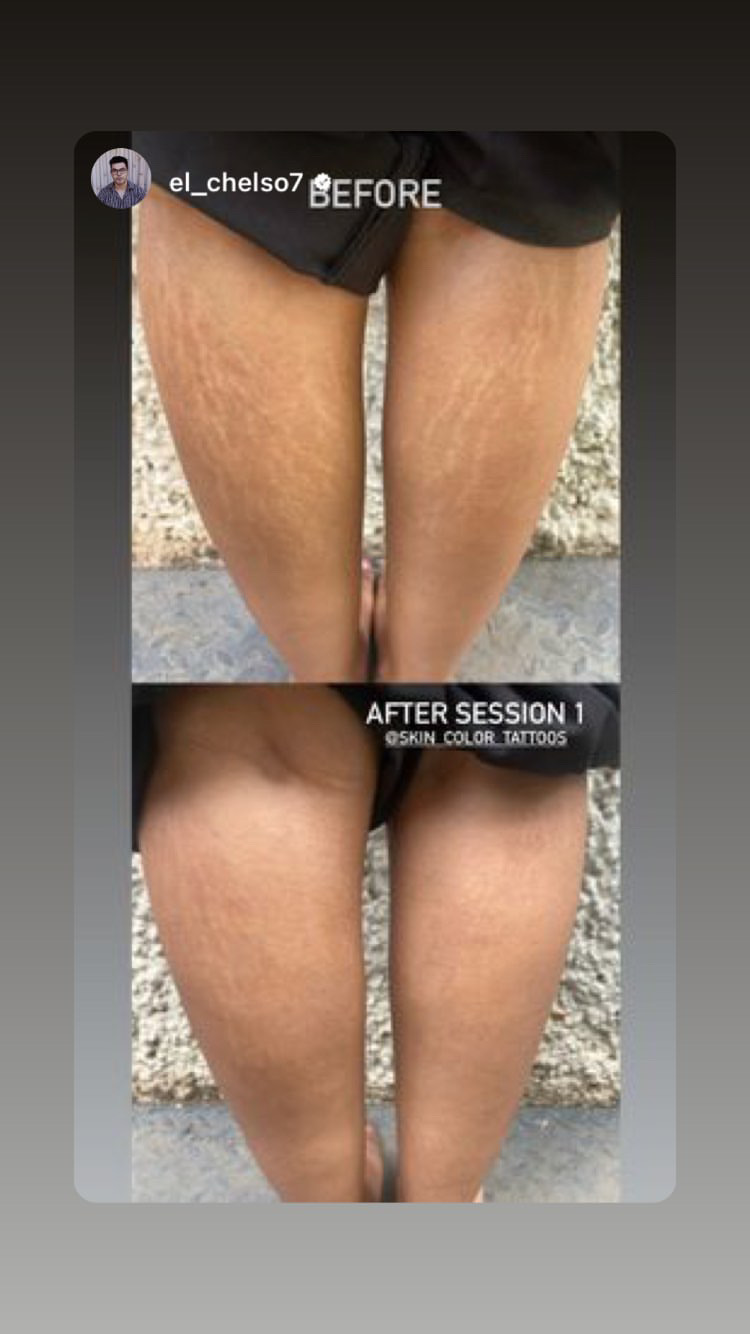 Camouflage Tattoos for Stretch marks and scar removal in India Client testimonial 1