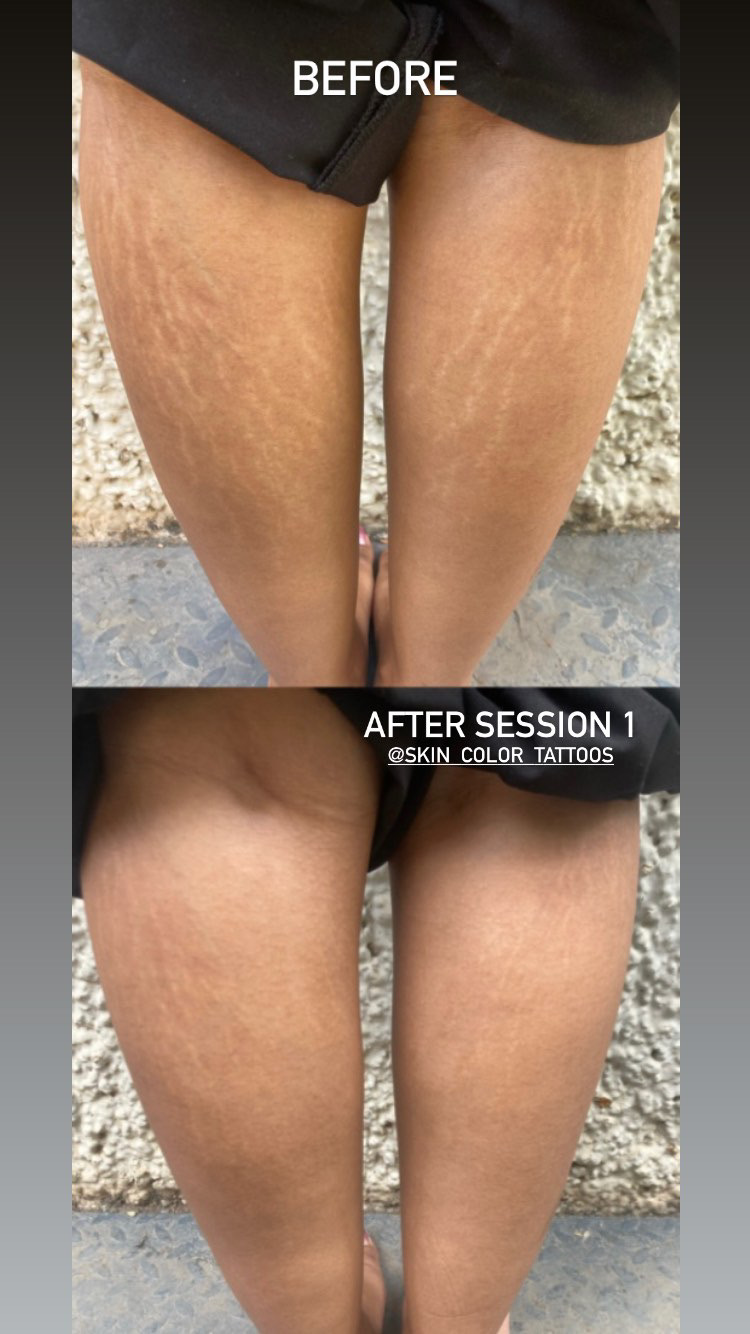 Camouflage Tattoos for Stretch marks and scar removal in India Scar camouflage before and after 3