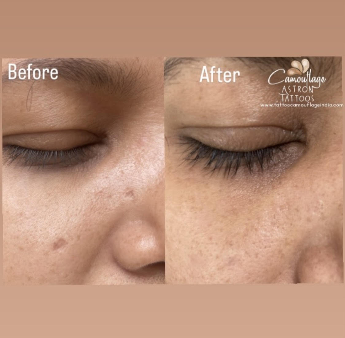 Camouflage Tattoos for Stretch marks and scar removal in India Client testimonial 3